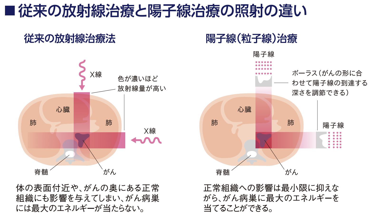 陽子線治療とは? | 保険企画サポート24